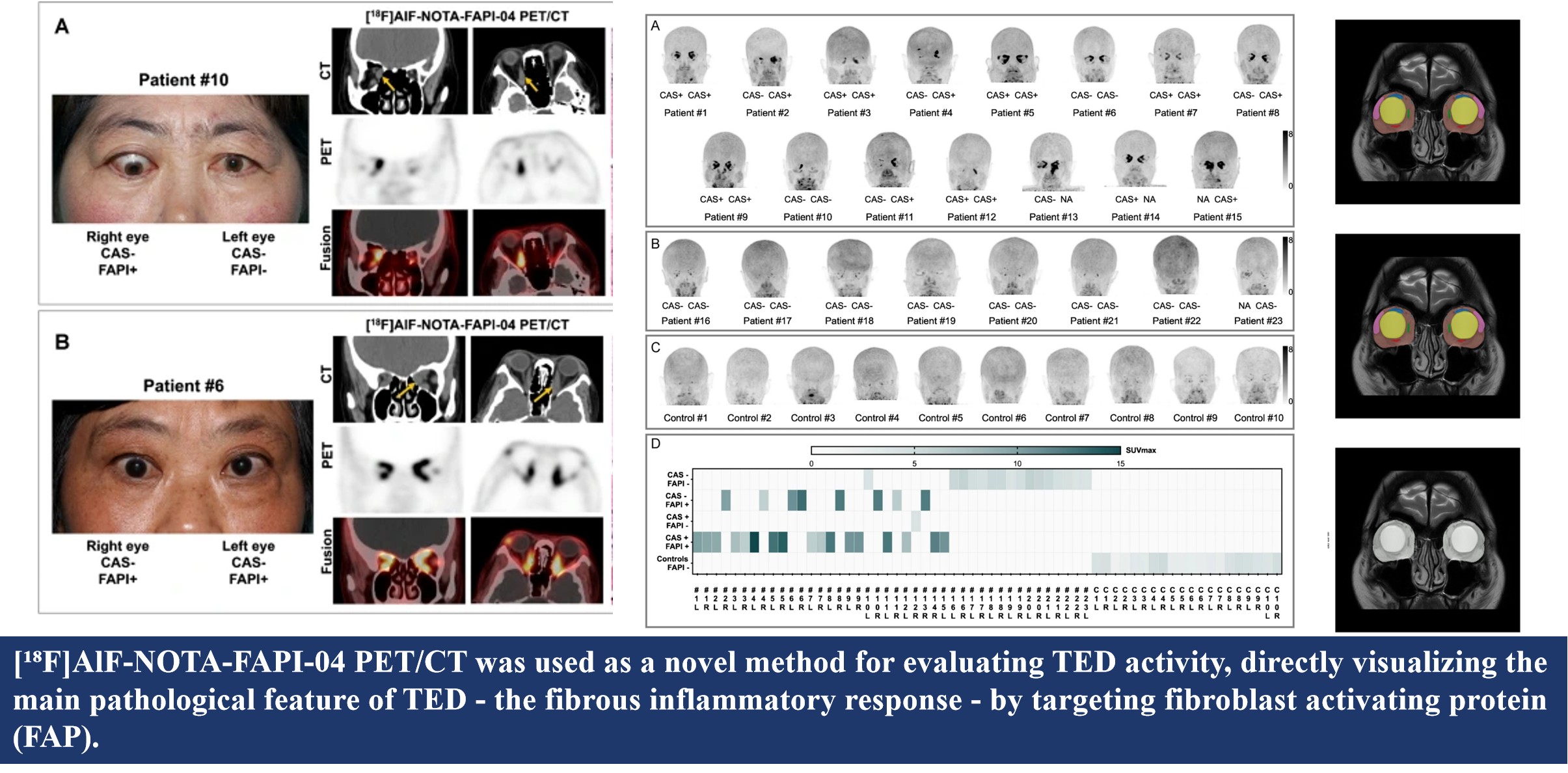FAPI PET/CT and deep learning–based multimodal fusion for Graves’ ophthalmopathy